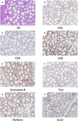 Single-Cell RNA-seq Reveals Characteristics of Malignant Cells and Immune Microenvironment in Subcutaneous Panniculitis-Like T-Cell Lymphoma